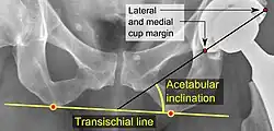 Acetabular inclination.[95] This parameter is calculated on an anteroposterior radiograph as the angle between a line through the lateral and medial margins of the acetabular cup and the transischial line which is tangential to the inferior margins of the ischium bones.[95]
