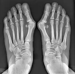 Before_syndesmosis_surgery