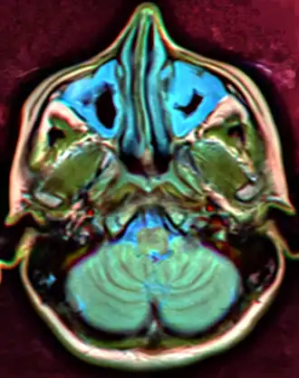MRI image showing sinusitis. Edema and mucosal thickening appear in both maxillary sinuses.