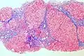 Trichrome stain, showing cirrhosis as a nodular texture surrounded by fibrosis (wherein collagen is stained blue)