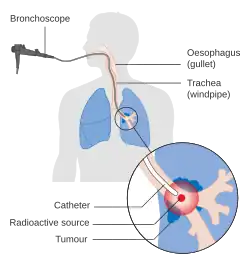 A machine attached to a tube that goes into a person's mouth and into a bronchus. At the end, an object emits radiation at a lung tumor.