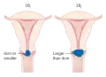 Stage 1B cervical cancer