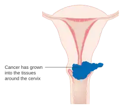 Stage 2B cervical cancer