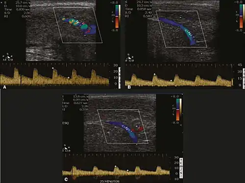 Longitudinal, ventral ultrasound of the penis, with pulsed mode and color Doppler. Flow of the cavernous arteries at 5, 15, and 25 min after prostaglandin injection (A, B, and C, respectively). The cavernous artery flow remains below the expected levels (at least 25–35 cm/s), which indicates ED due to arterial insufficiency.[48]