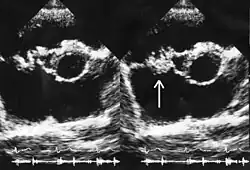 Side-by-side echocardiogram cross-sections of a human heart. In the second image a white arrow points at a mass on the tricuspid valve.