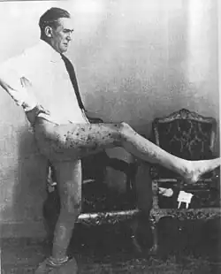 Rodolfo Graziani after surviving an attempt on his life