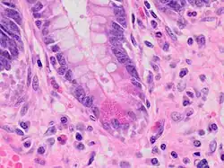 Paneth cell (pictured) or gastric metaplasia (only applies in the left colon and rectum)