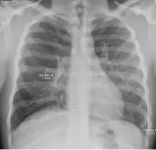 Chest x-ray showing Kerley B line due to interstitial oedema (in children only) of primary pulmonary tuberculosis.
