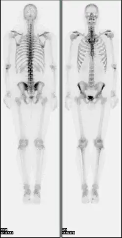 A nuclear medicine whole body bone scan. The nuclear medicine whole body bone scan is generally used in evaluations of various bone-related pathology, such as for bone pain, stress fracture, nonmalignant bone lesions, bone infections, or the spread of cancer to the bone.
