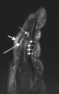 T2-weighted MRI (sagittal) of index finger in PsA (mutilans form) showing probable erosion (increased signal) at base of the middle phalanx (long thin arrow), synovitis at the proximal interphalangeal joint (long thick arrow), soft tissue edema (short thick arrow), and diffuse bone edema (short thin arrows) of the proximal phalanx.